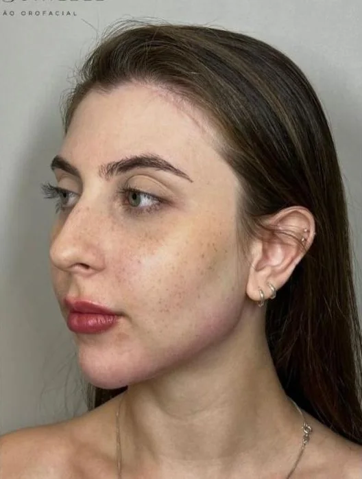 Perfil facial após o tratamento